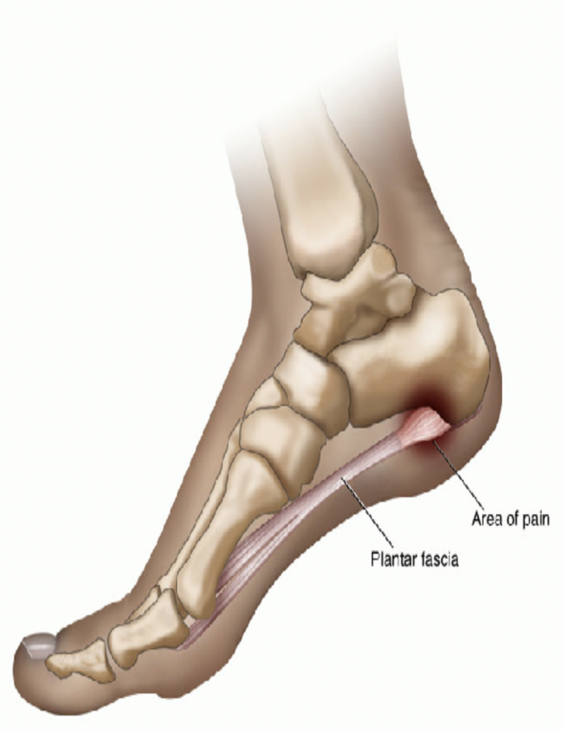 Plantar Fasciitis - Western Montana Foot & Ankle