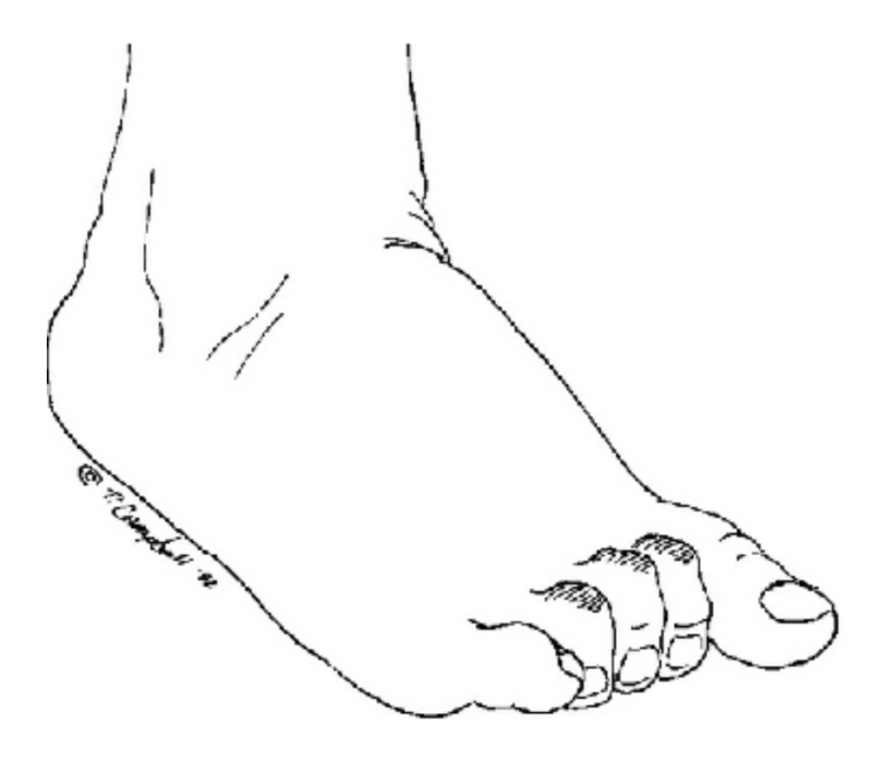 Digital Deformities - Western Montana Foot & Ankle