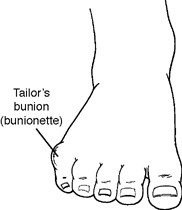Image of a right foot showing what a tailor's bunion (bunionette) looks like.