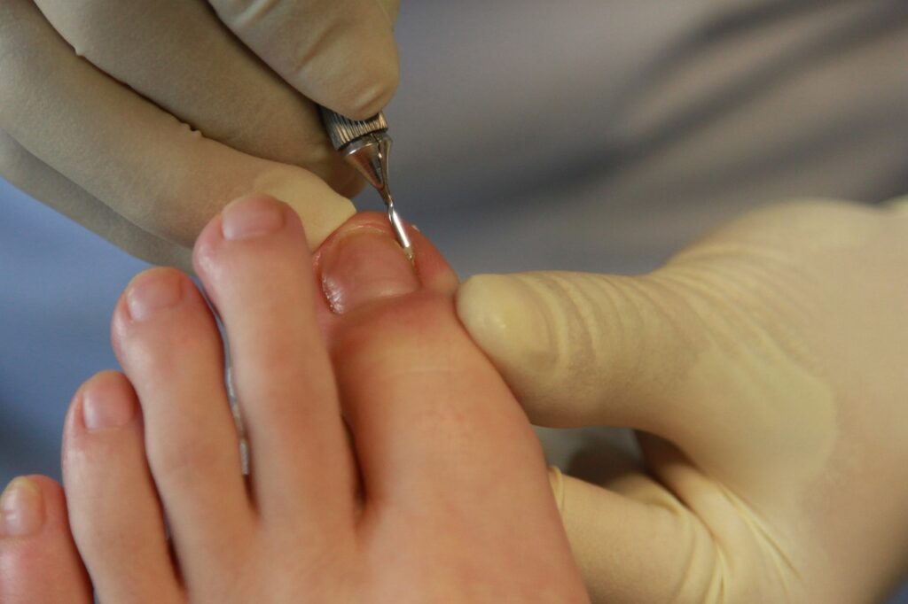 Ingrown toenail being worked on by gloved hands and tool